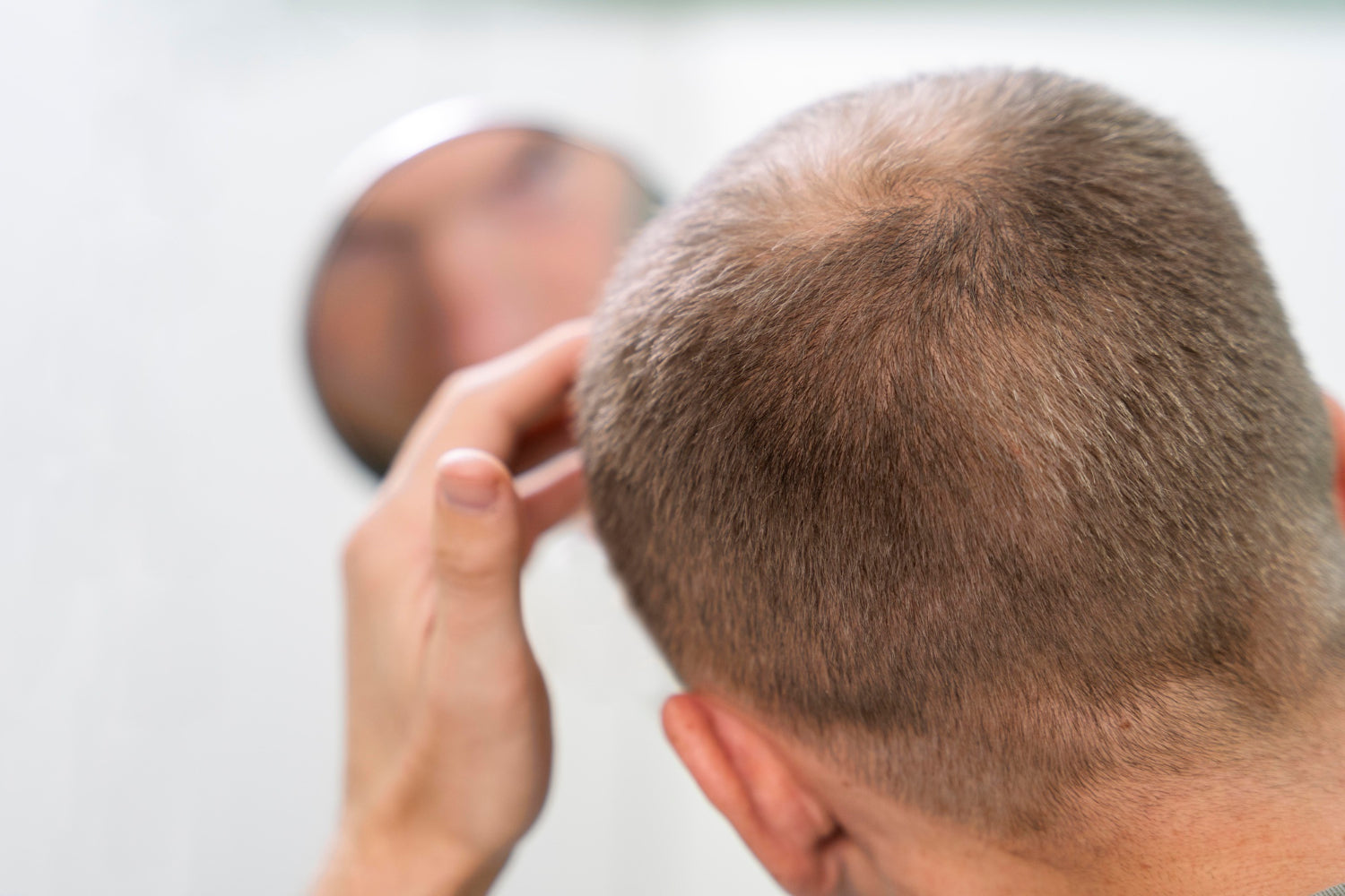 Alopecia Areata: Od príčiny k liečbe - Čo potrebujete vedieť